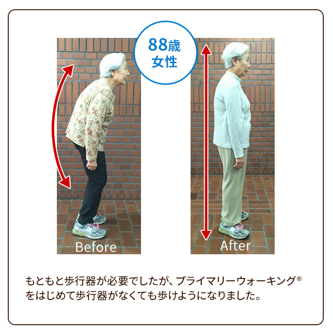 もともと歩行器が必要でしたが、プライマリーウォーキング(R)をはじめて歩行器がなくても歩けようになりました。
